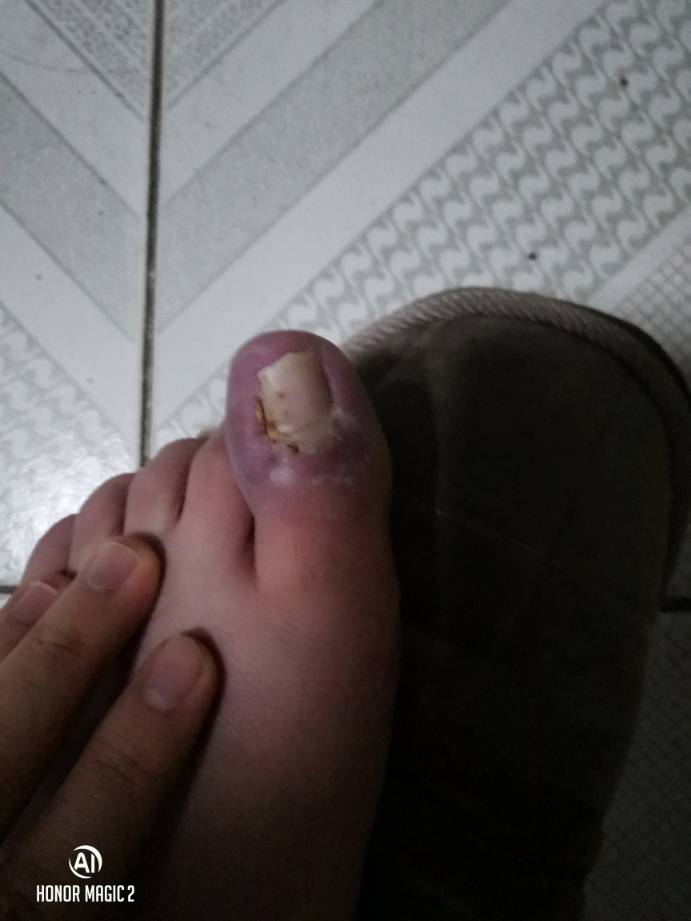 B体育-灰熊JJJ正式接受脚趾手术三个月后重新评估的简单介绍